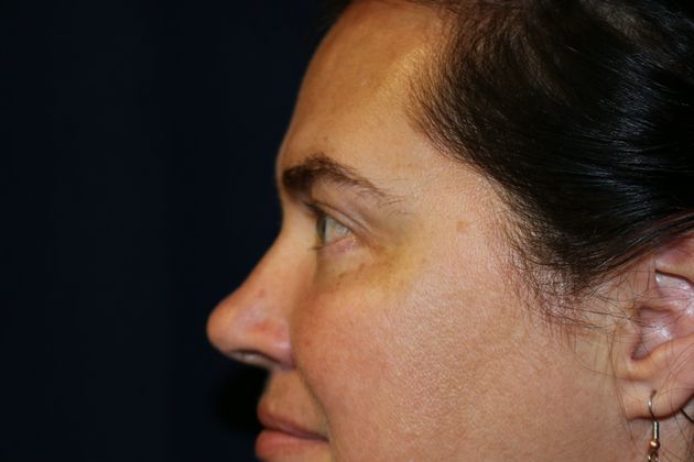Eye Lift*: Case 6 - After