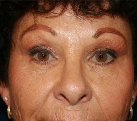 Forehead & Brow Lifts*: Case 1 - Front After