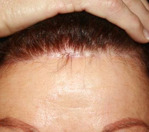 Forehead & Brow Lifts*: Case 1 - Before