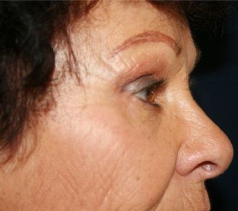 Forehead & Brow Lifts*: Case 1 - After