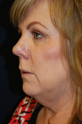 KYBELLA™ *: Kybella 3 - Before