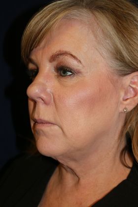 KYBELLA™ *: Kybella 3 - After
