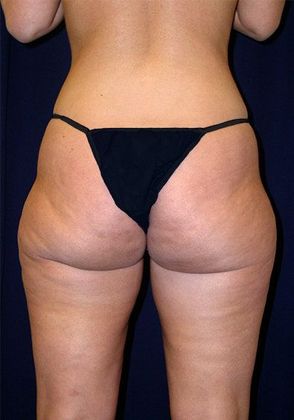 Liposuction & Safe Lipo: Case 1 - Back Before