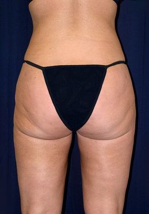 Liposuction & Safe Lipo: Case 1 - Back After