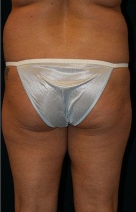 Liposuction & Safe Lipo: Case 2 - Back Before
