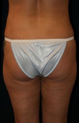 Liposuction & Safe Lipo: Case 2 - Back After