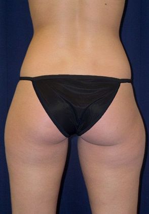 Liposuction & Safe Lipo: Case 3 - Back Before
