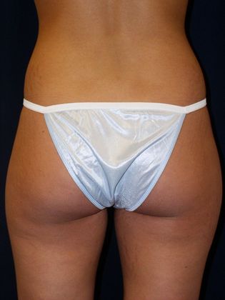 Liposuction & Safe Lipo: Case 4 - Before