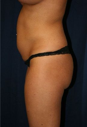 Liposuction & Safe Lipo: Case 6 - Side Before