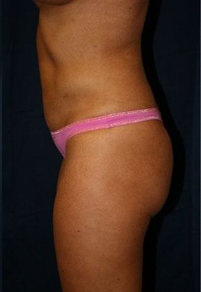 Liposuction & Safe Lipo: Case 6 - Side After
