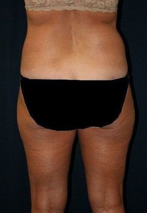 Liposuction & Safe Lipo: Case 9 - Back Before