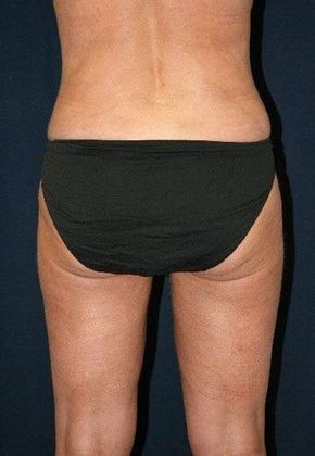 Liposuction & Safe Lipo: Case 9 - Back After