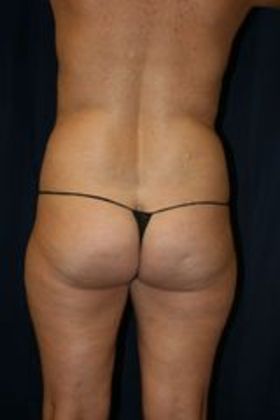 Liposuction & Safe Lipo: Case 12 - Before