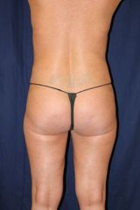 Liposuction & Safe Lipo: Case 12 - After