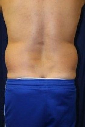 Liposuction & Safe Lipo: Case 13 - Before