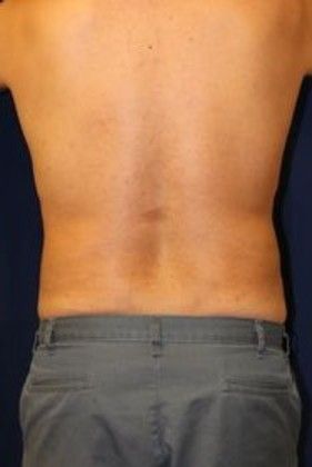 Liposuction & Safe Lipo: Case 13 - After