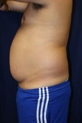 Liposuction & Safe Lipo: Case 13 - Before