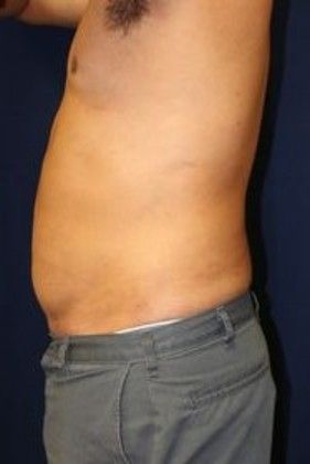 Liposuction & Safe Lipo: Case 13 - After