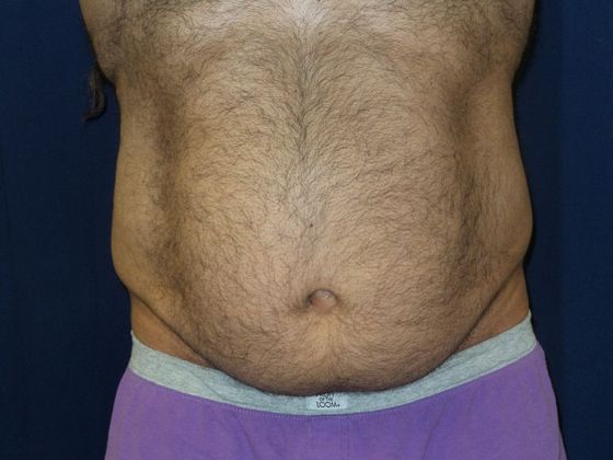 Liposuction & Safe Lipo: Case 18 - Before