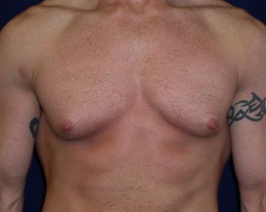 Male Breast Reduction*: Case 1 - Front Before