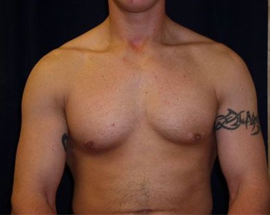 Male Breast Reduction*: Case 1 - Front After