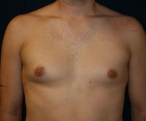 Male Breast Reduction*: Case 2 - Front Before