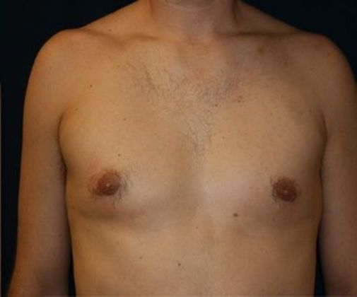 Male Breast Reduction*: Case 2 - Front After