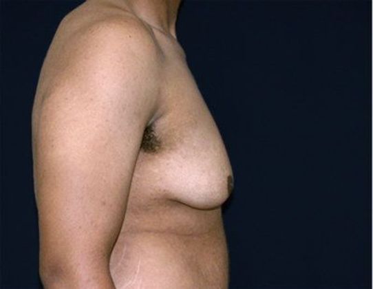 Male Breast Reduction*: Case 3 - Side Before