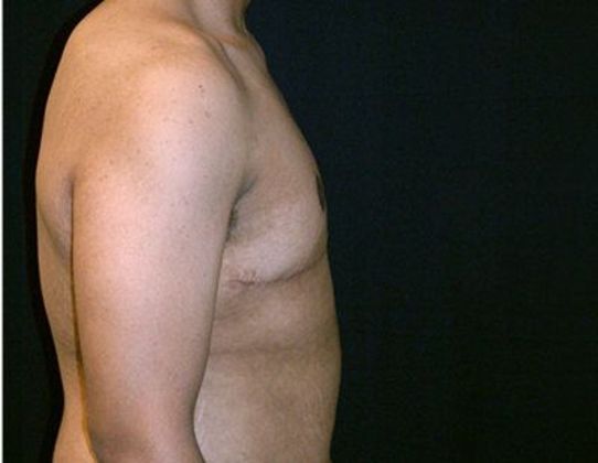 Male Breast Reduction*: Case 3 - Side After