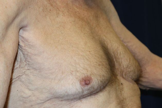 Male Breast Reduction*: Case 4 - Before
