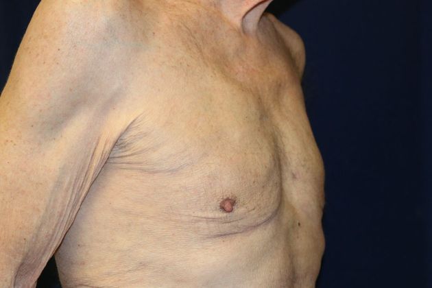 Male Breast Reduction*: Case 4 - After