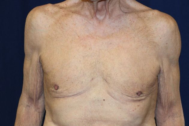 Male Breast Reduction*: Case 4 - After