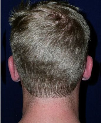 Otoplasty*: Case 3 - Back After