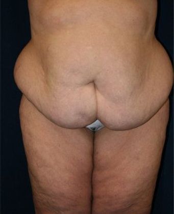 Tummy Tuck*: Case 6 - Front Before