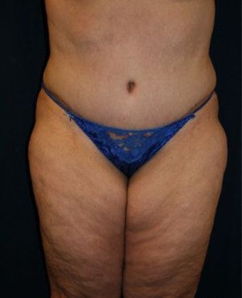 Tummy Tuck*: Case 6 - Front After