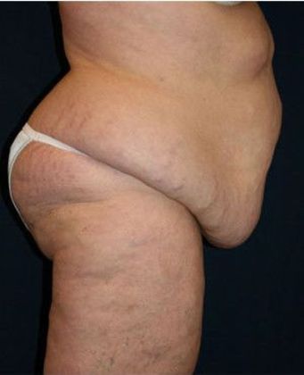 Tummy Tuck*: Case 6 - Side Before