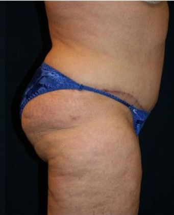 Tummy Tuck*: Case 6 - Side After