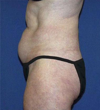 Tummy Tuck*: Case 12 - Side Before