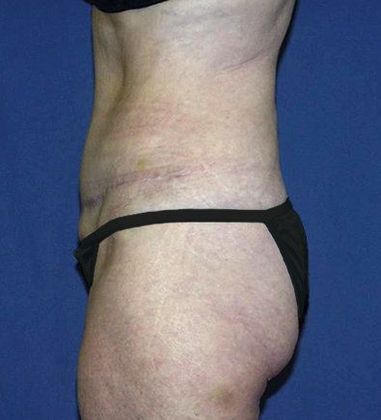 Tummy Tuck*: Case 12 - Side After