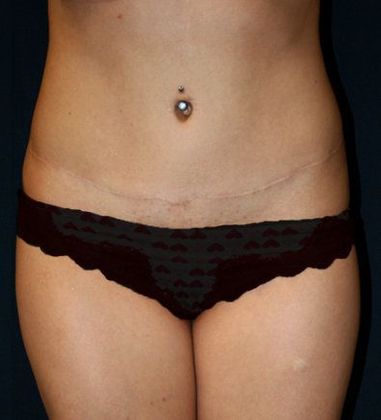 Tummy Tuck*: Case 14 - Front After