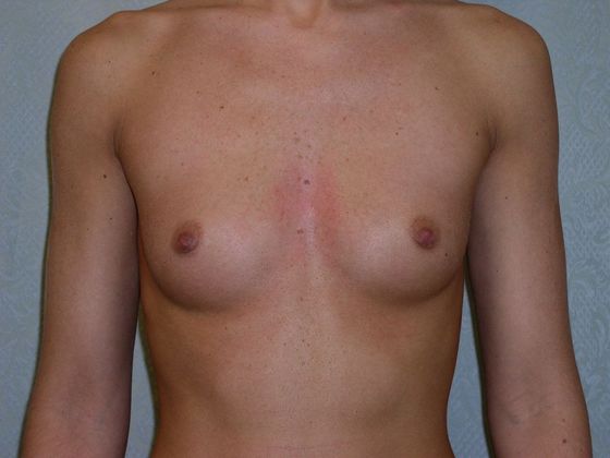 Breast Augmentation*: Case 4 - Front Before