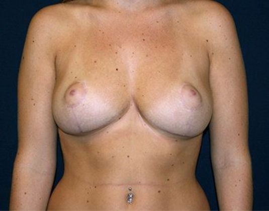 Breast Lift*: Case 4 - Front After