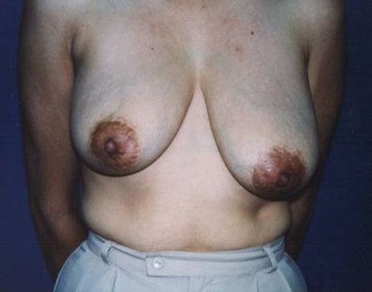 Breast Lift*: Case 6 - Front Before