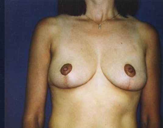 Breast Lift*: Case 6 - Front After