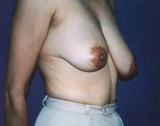 Breast Lift*: Case 6 - Side Before