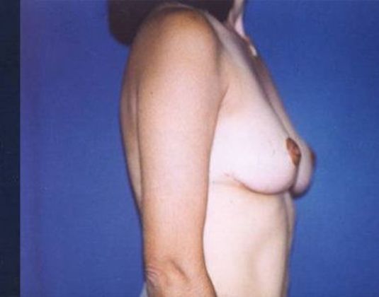Breast Lift*: Case 6 - Side After