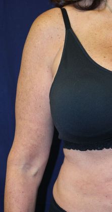 Arm Lift*/Arm Sculpting: Case 1 - Before Front