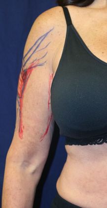 Arm Lift*/Arm Sculpting: Case 1 - Before Front Marked