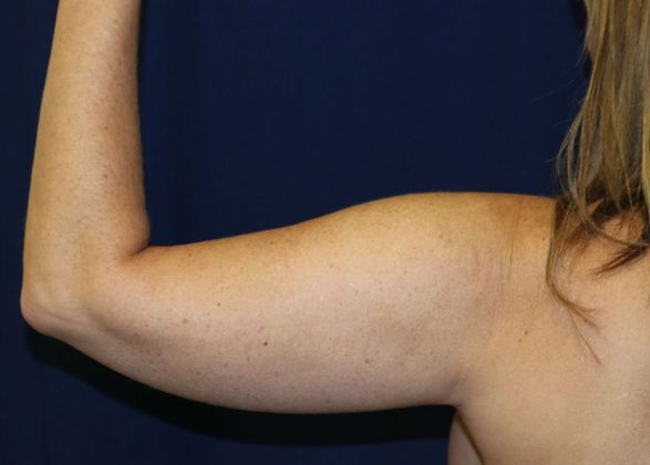 Arm Lift*/Arm Sculpting: Case 2 - Before Back