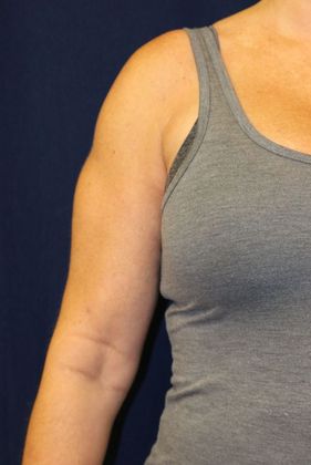 Arm Lift*/Arm Sculpting: Case 2 - After Front